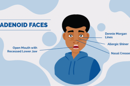 Adenoid Facies