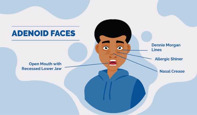 Adenoid Facies