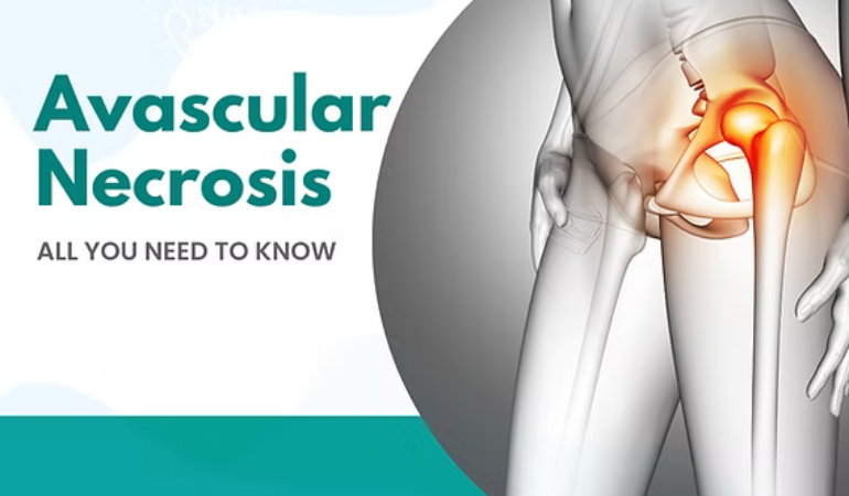 Homeopathic Medicine for Avascular Necrosis